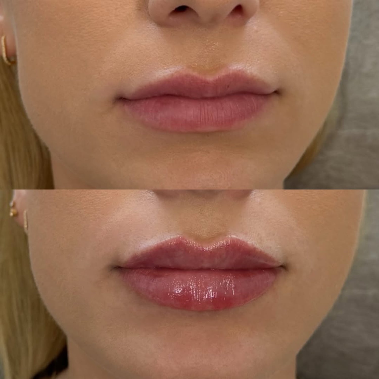 Filler behandling kursus