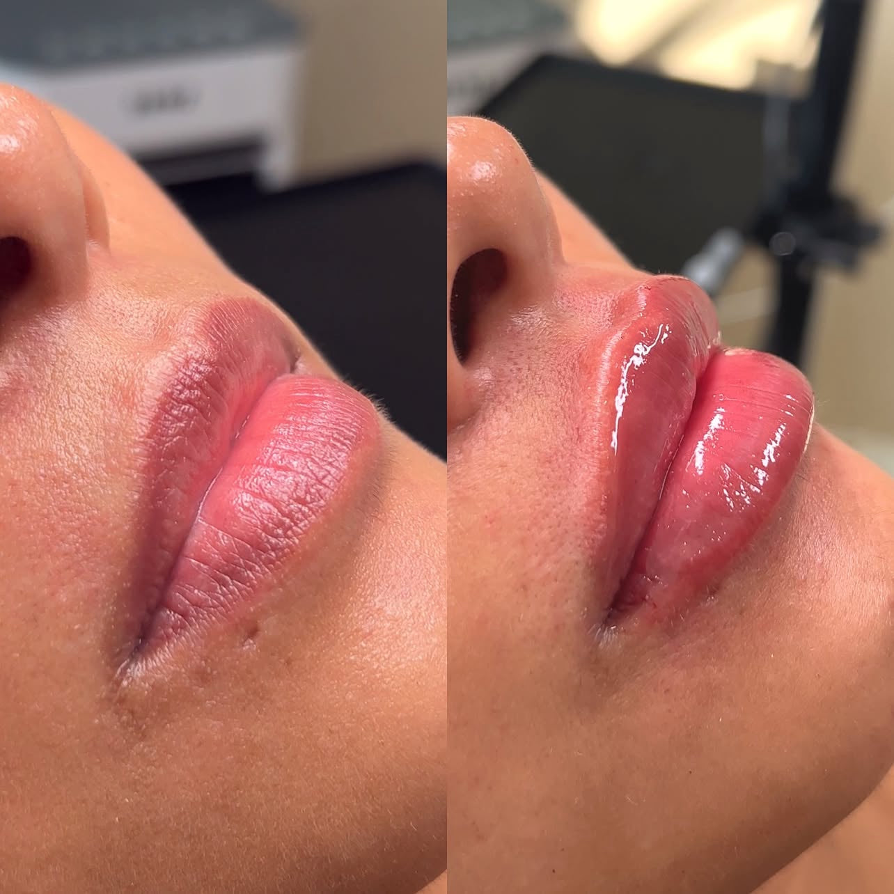 Få et kursus i filler behandling