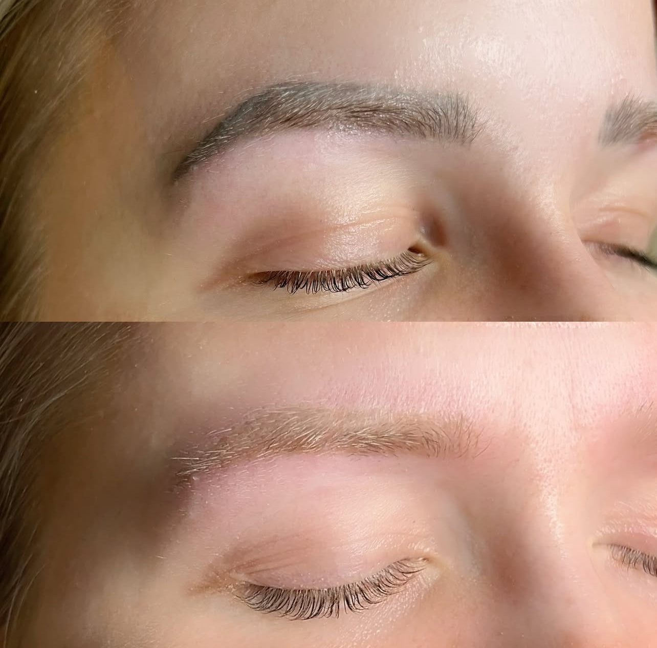 Fjernelse af tatoveringer i ansigtet