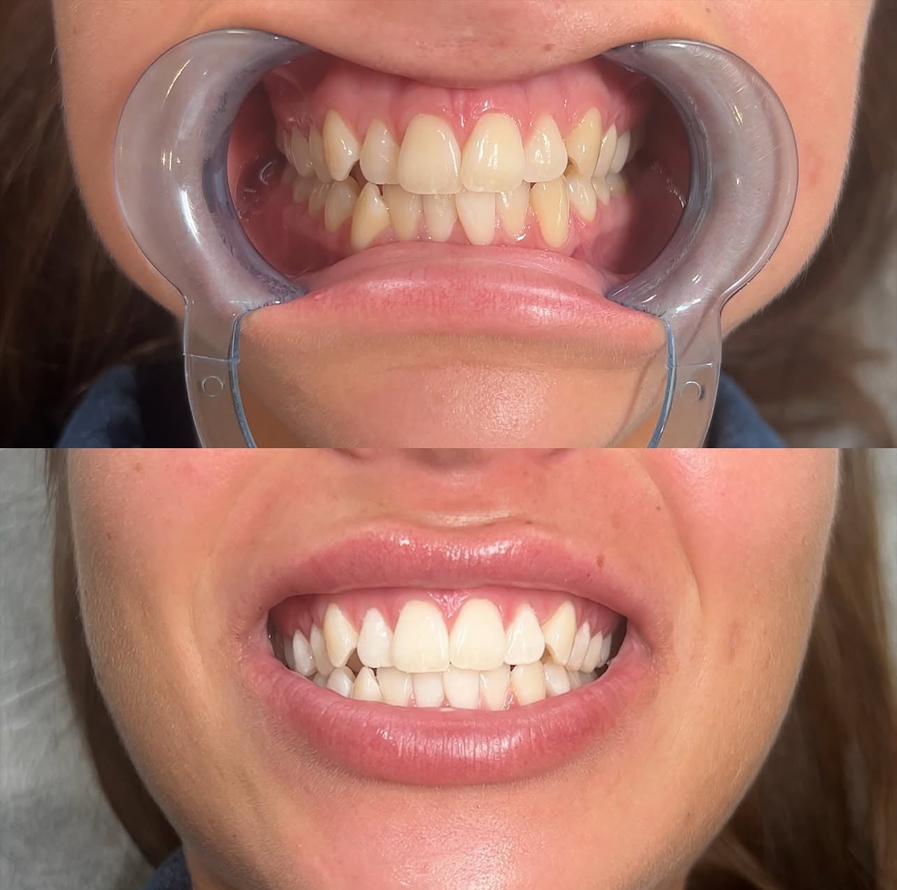 resultat for 1 behandling