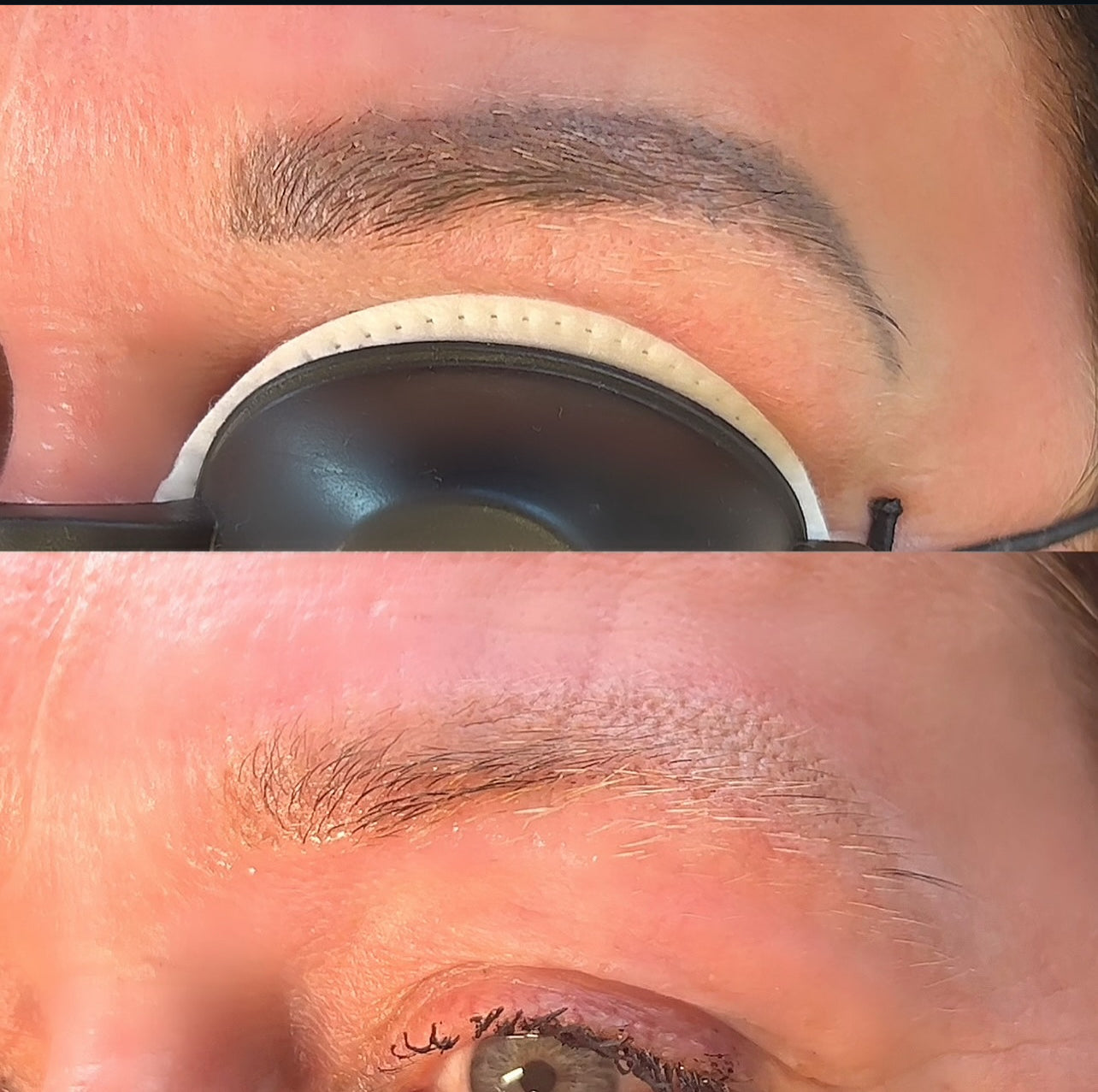 fjernelse af tatoveringer