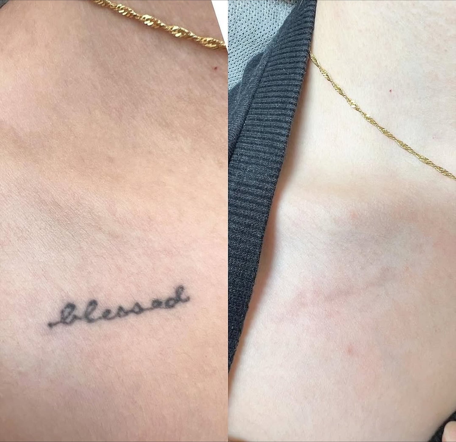 fjernelse af tatoveringer med få behandlinger