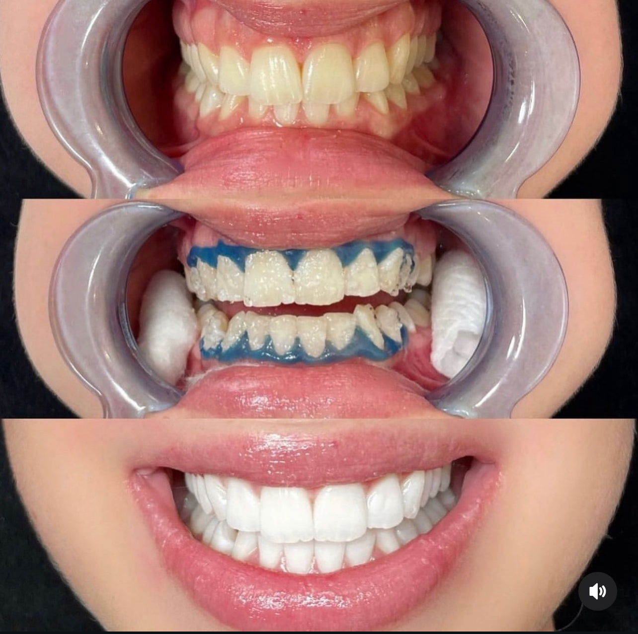 resultat for 1 behandling